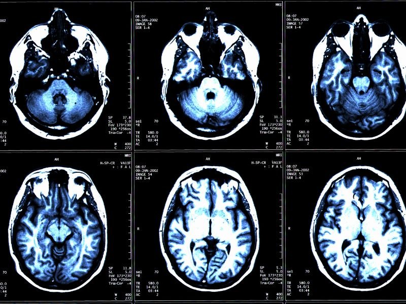 Cirurgia de coluna minimamente invasiva em Criciúma
