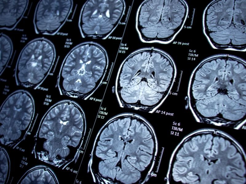Cirurgia para aneurisma intracraniano em Tubarão, SC