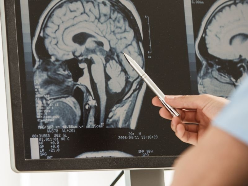 Procedimentos Minimamente Invasivos para Tumores Cerebrais