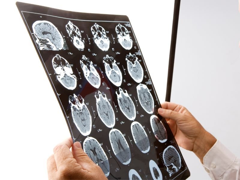 Tratamento de Glioma em Criciúma