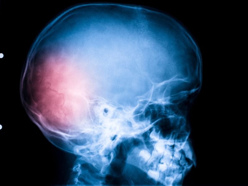 Especialista em Derrame Cerebral em Criciúma